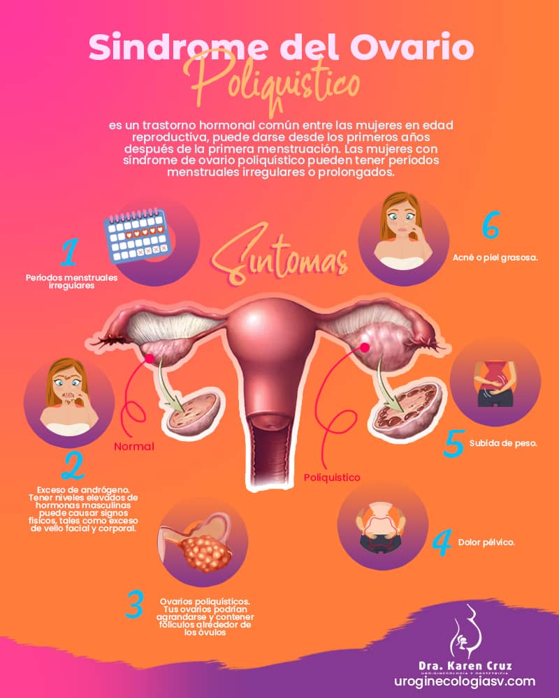 Uroginecologia El Síndrome Del Ovario Poliquístico 3321